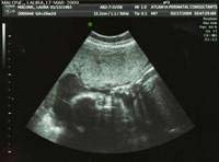Katie Ultrasound